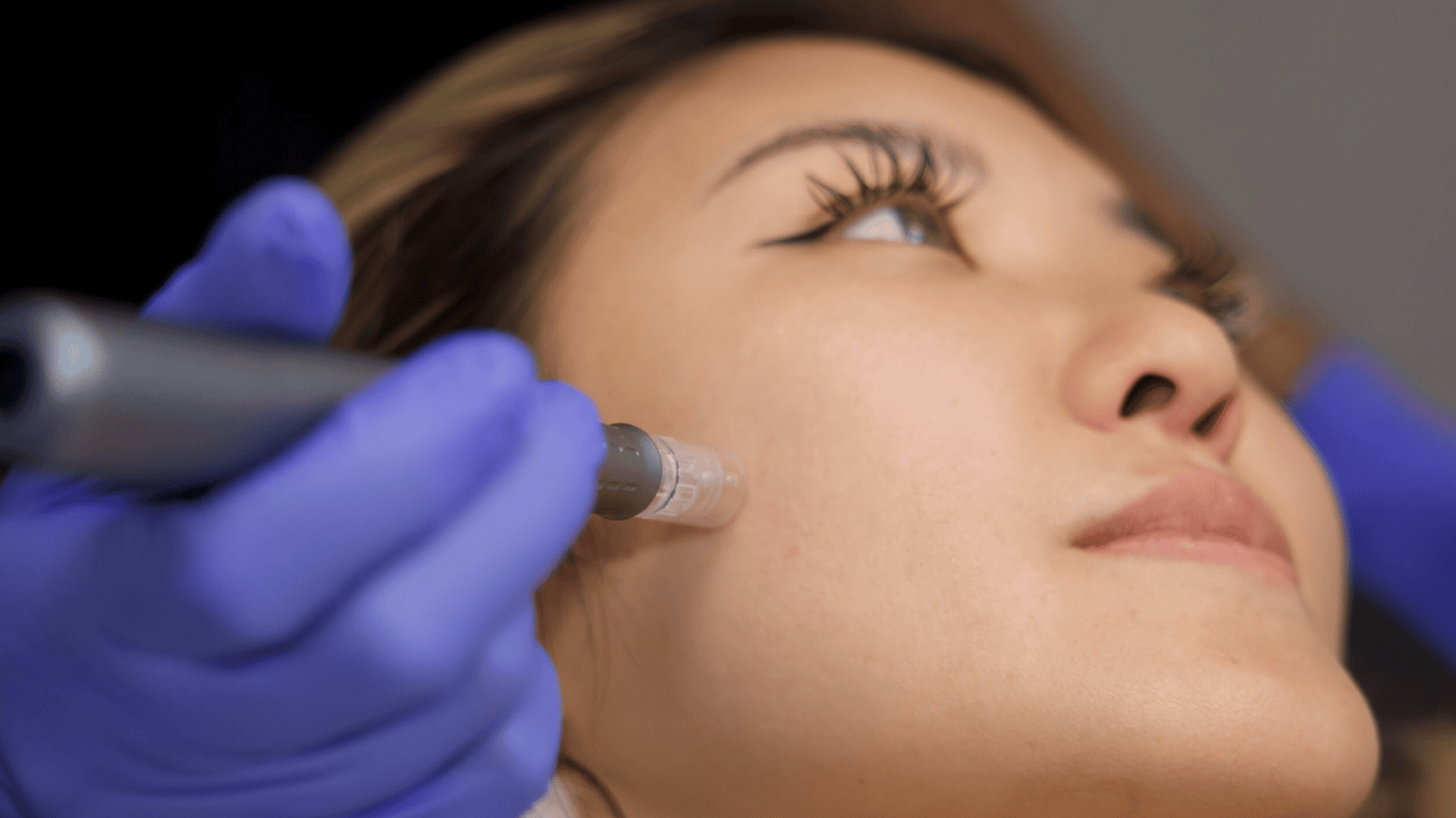 Atelier Confidence Microneedling